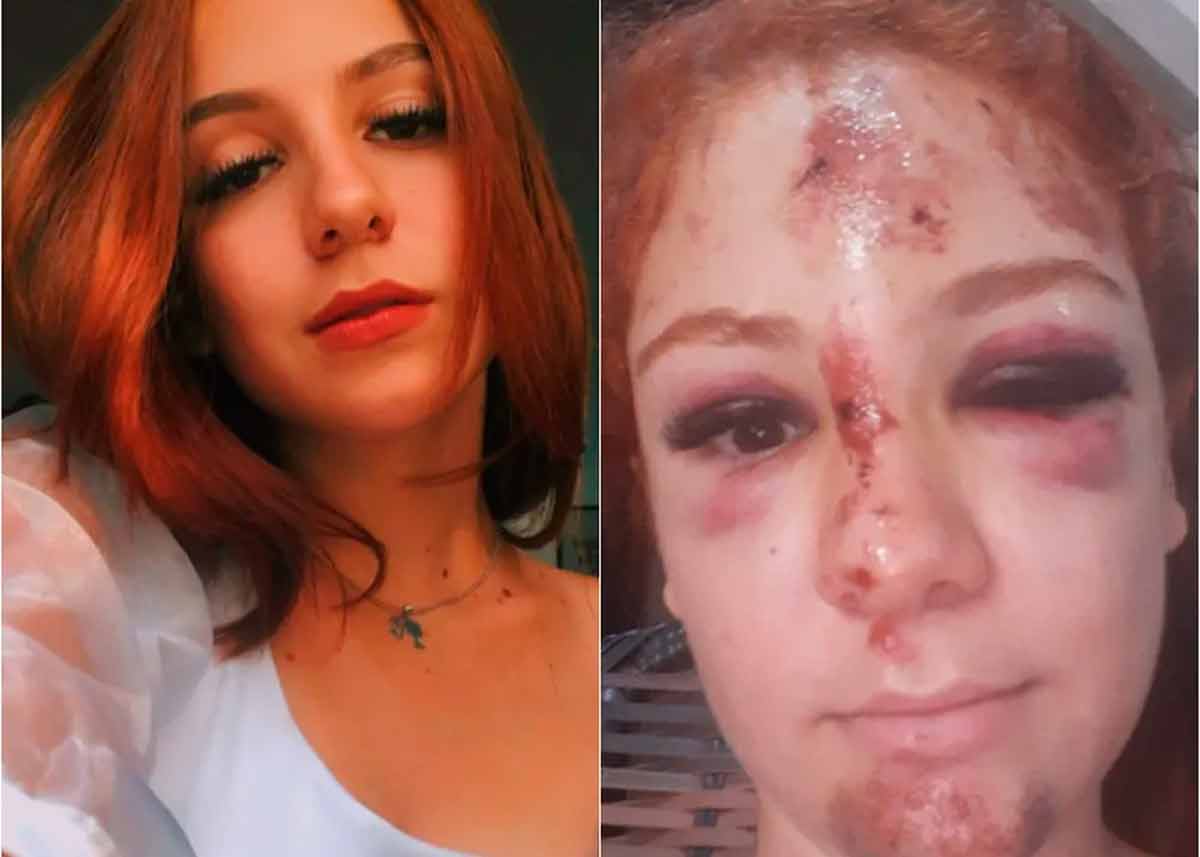 Jovem de 20 anos atropela onça e fica com rosto desfigurada após a queda. Foto: Reprodução redes sociais